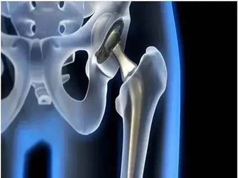 Kako legure titana harmonično koegzistiraju s ljudskim tkivom?